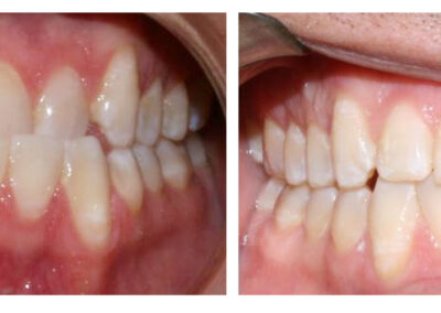 Orthodontics - Before & After